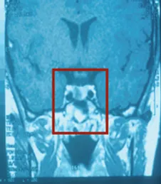 A picture of the face and head in an mri.